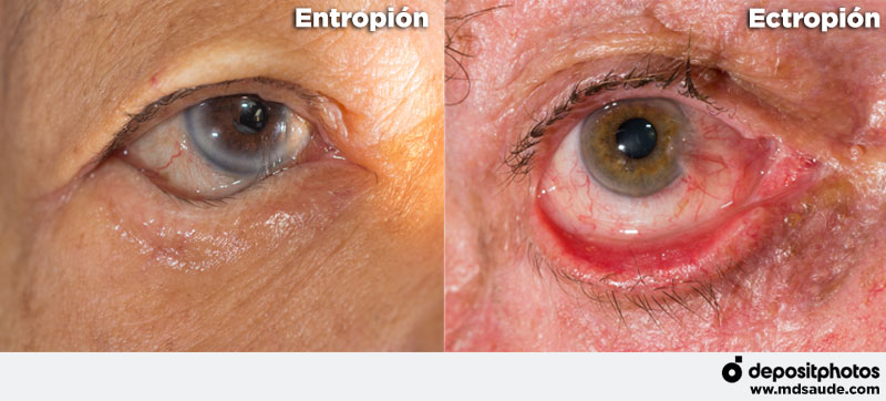 entropión y ectropión