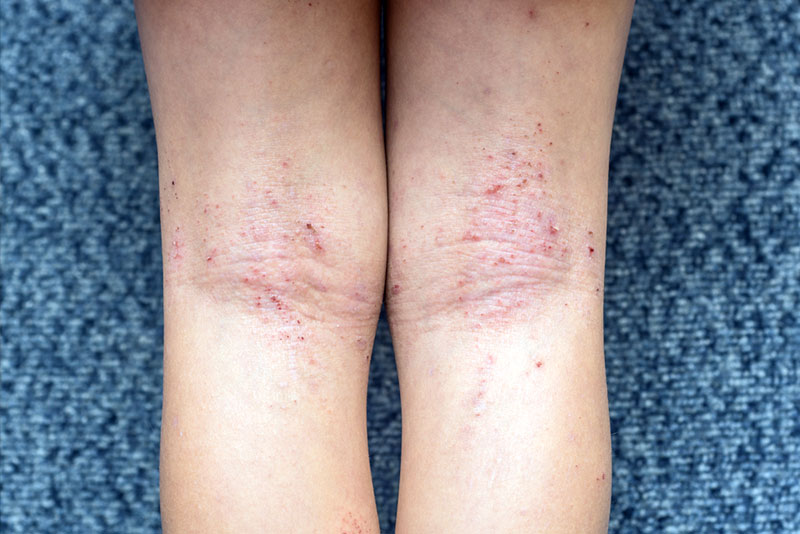 dermatitis atópica