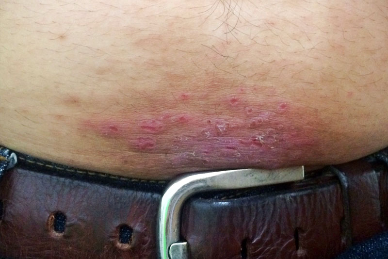 Dermatitis de contacto