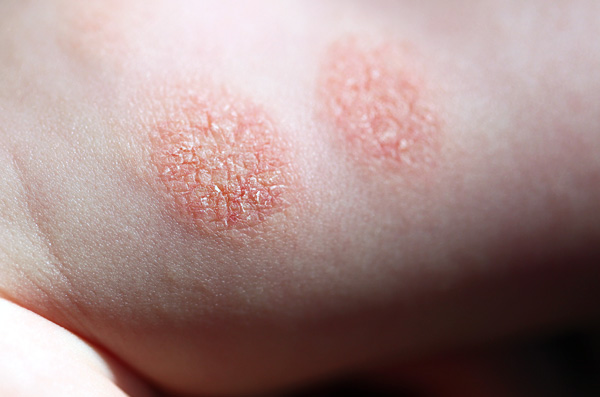 Eczema numular - foto 4