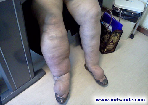 Linfedema: edema linfático