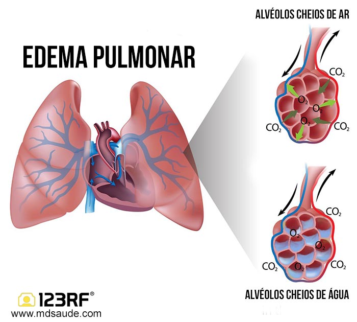 Edema pulmonar agudo