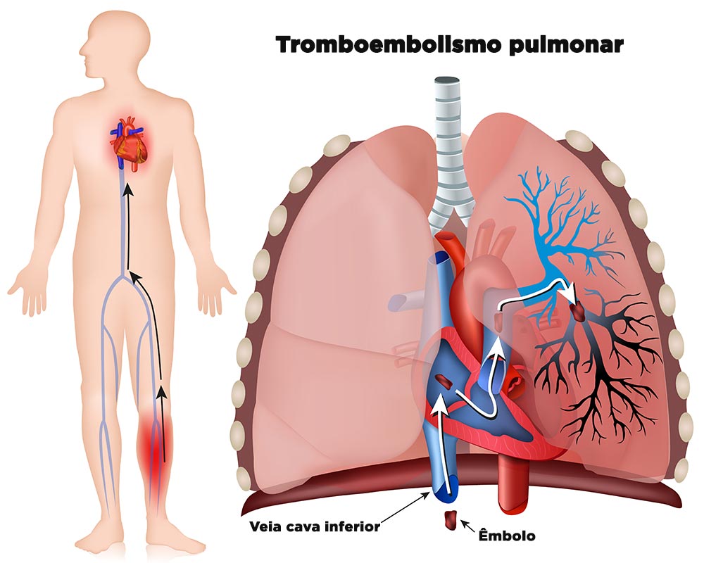 Ilustração mostrando como um êmbolo originado em uma TVP do membro inferior pode se transformar em um tromboembolismo pulmonar