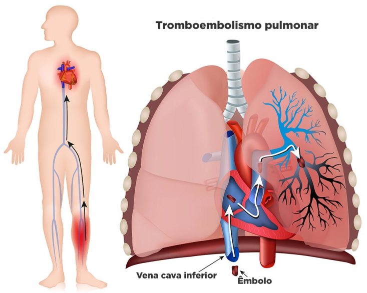 Tromboembolia pulmonar (TEP)