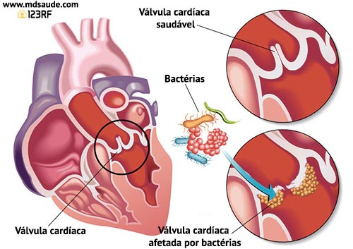 Endocardite bacteriana
