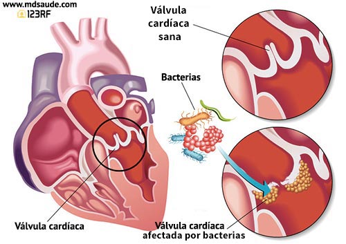 Endocarditis infecciosa