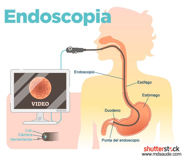 Endoscopia superior