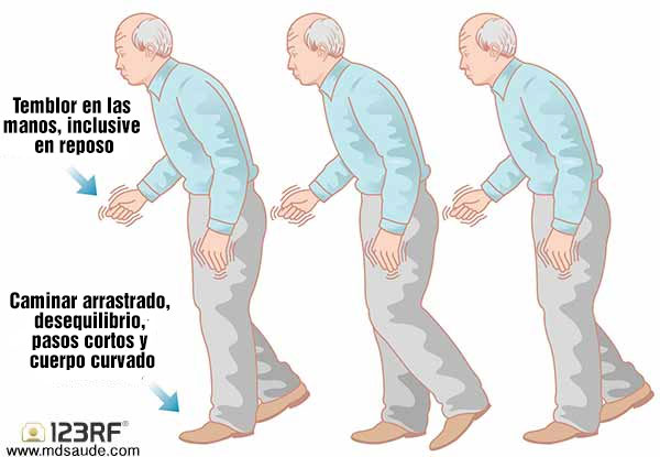 Signos de la enfermedad de parkinson
