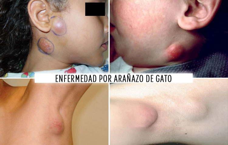 Linfadenopatía por enfermedad por arañazo de gato