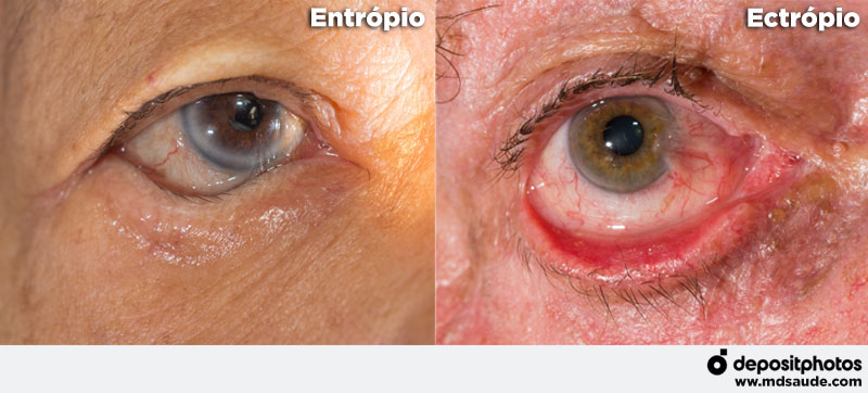 Entrópio e ectrópio