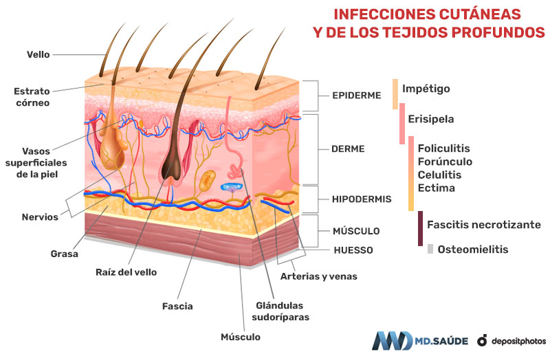 Infecciones de la piel según su profundidad