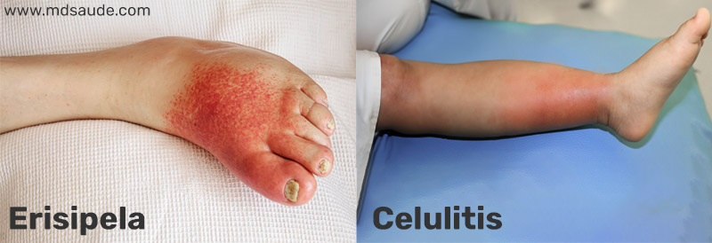 Diferencias entre erisipela y celulitis.