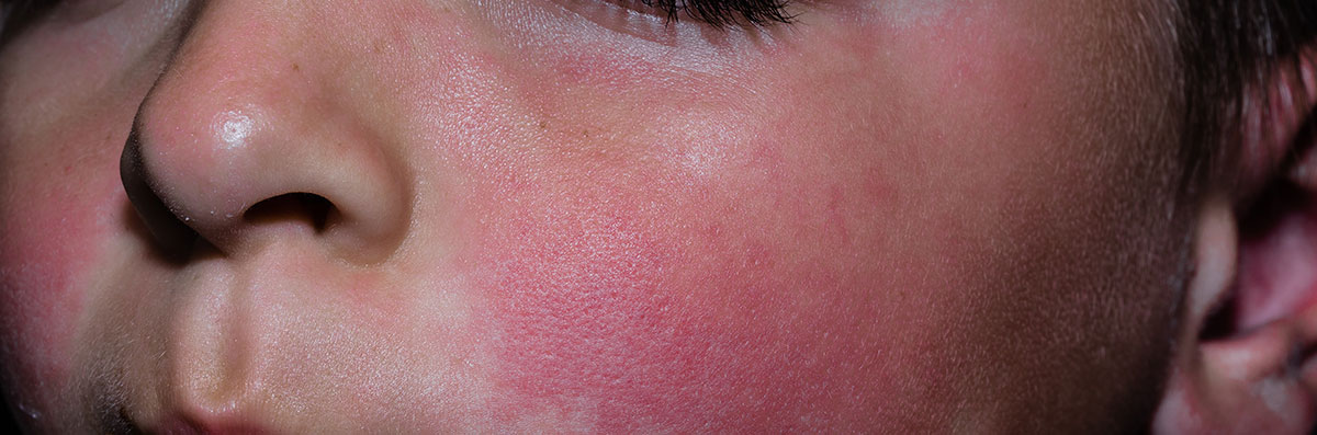 Rash na face do eritema infeccioso