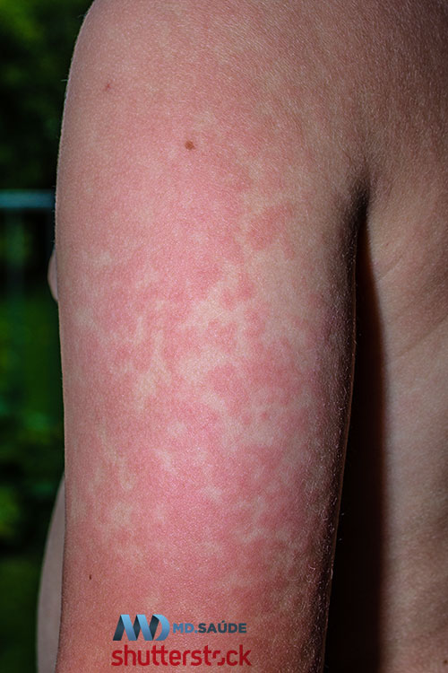 Rash do eritema infeccioso no braço