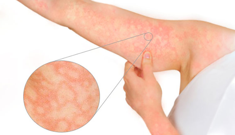 Rash do eritema infeccioso