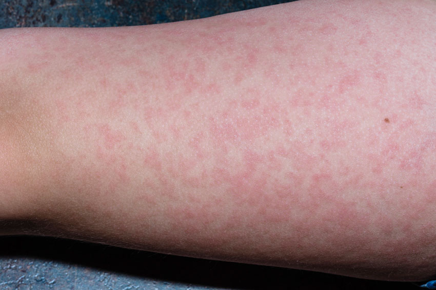 Rash do eritema infeccioso