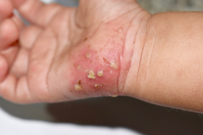 Escabiose com infecção bacteriana secundária