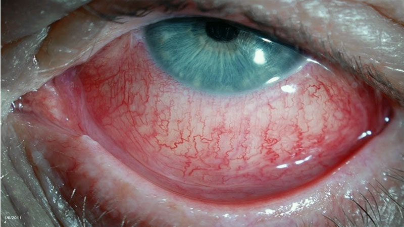 Esclerite - olhos difusamente vermelhos, com dor forte e lacrimejamento.
