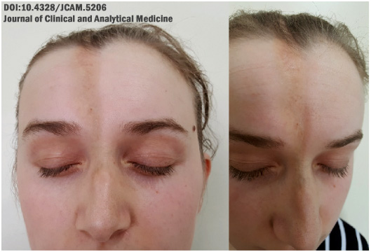 Esclerodermia: lesão hiperpigmentada em "coup de sabre"