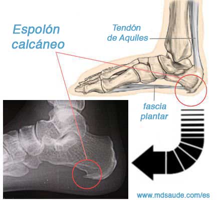 Espolón calcáneo