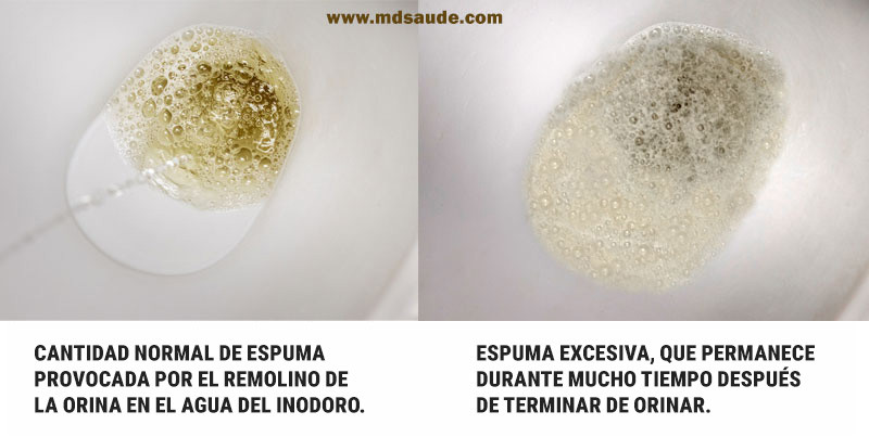 Espuma en la orina