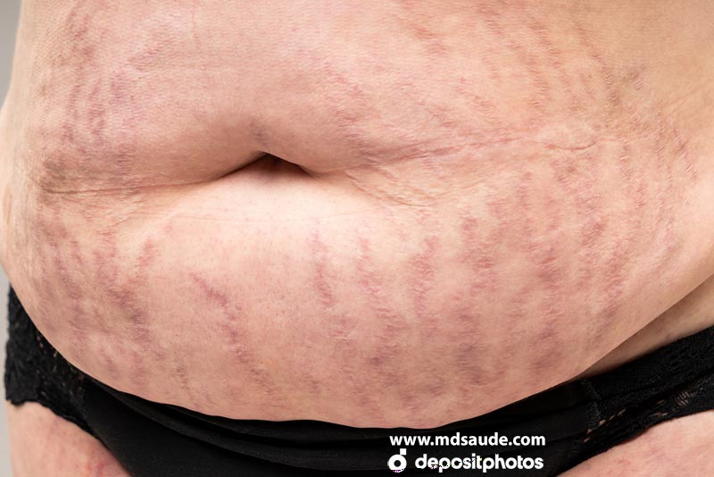 Estrias rubras no abdomen provocas pelo uso de corticoides