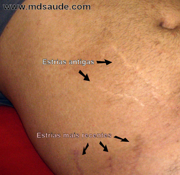 Estrias novas e antigas