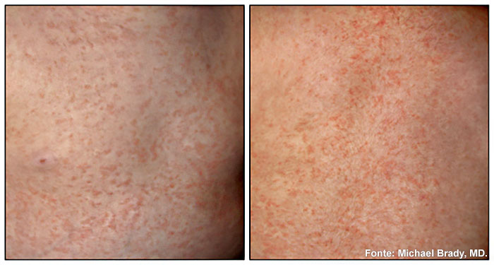 Rash do exantema súbito
