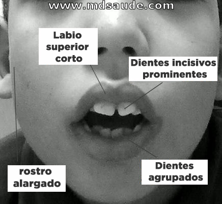 facies adenoidea