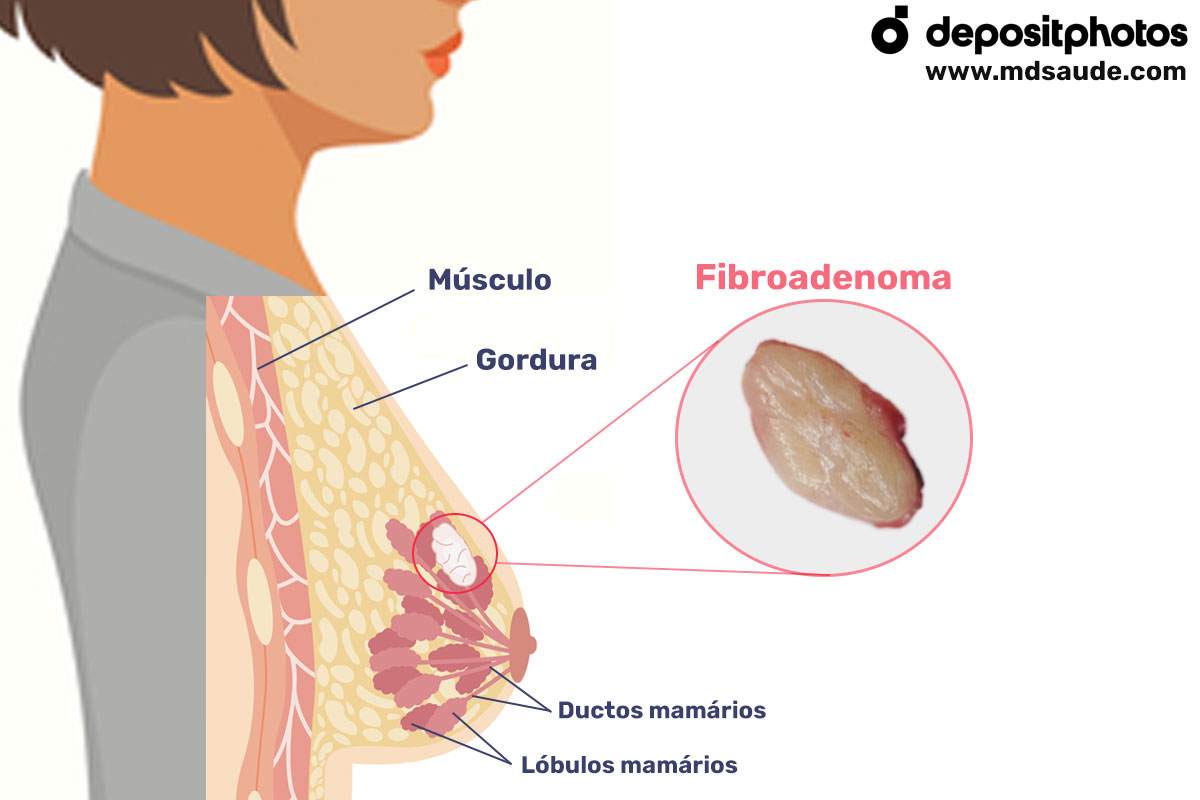 Fibroadenoma