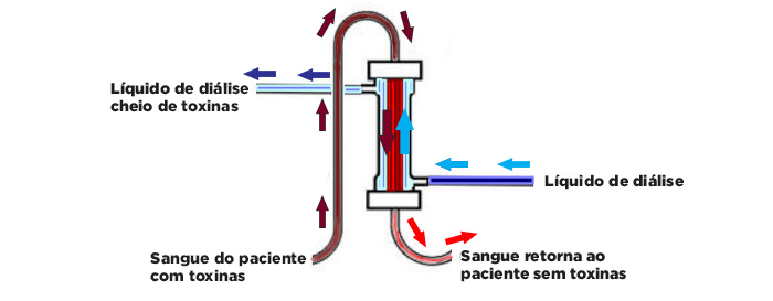 Filtro de hemodiálise