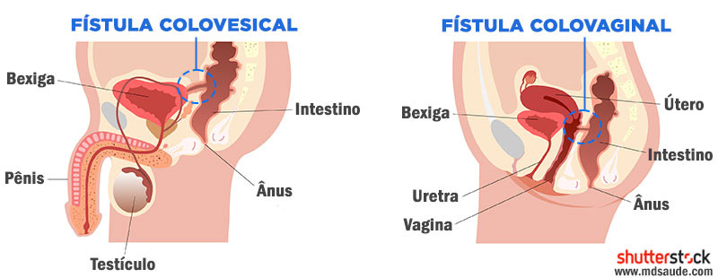 Fístulas provocadas por diverticulite aguda