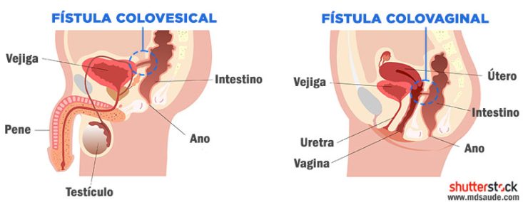 Fístulas causadas por diverticulitis aguda