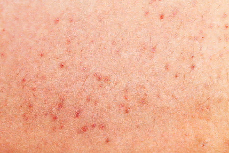 Foliculite na perna sem pus.