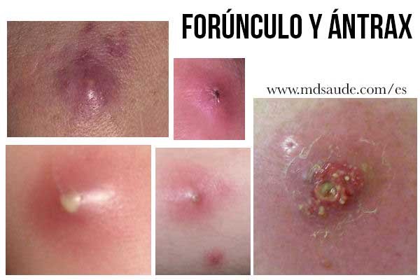 Forúnculos