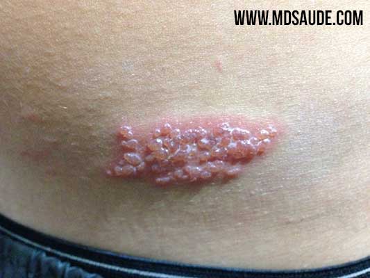 Herpes zoster (shingles)