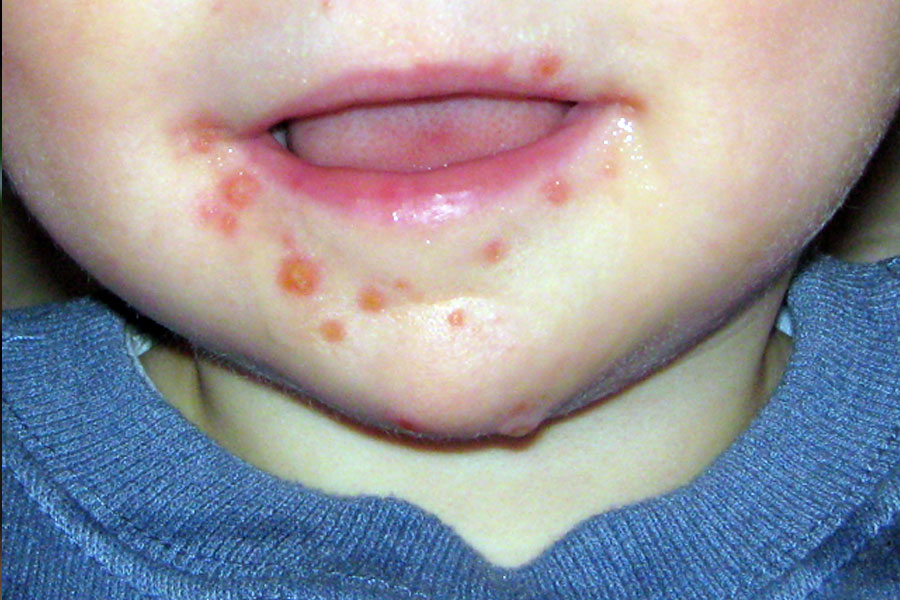 Mão-pé-boca lesão oral