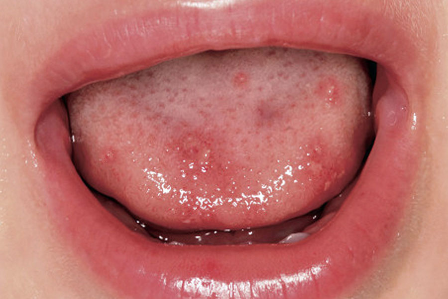 Mão-pé-boca lesão oral
