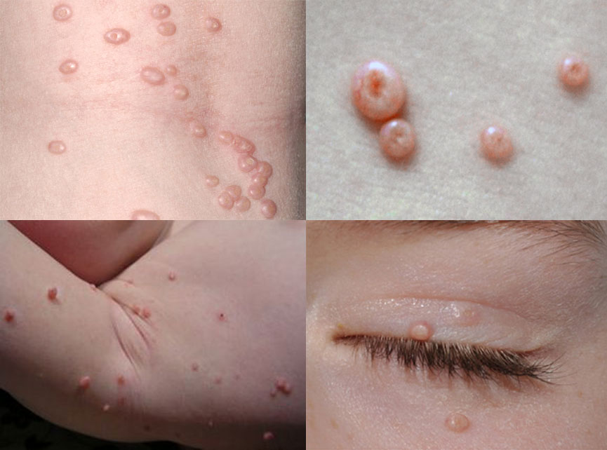 Imágenes de lesiones de molusco contagioso