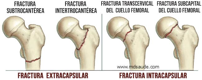 Tipos de fractura de cadera