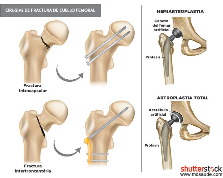 Cirugías de fractura de cuello femoral
