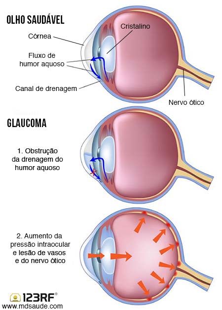 Como surge o glaucoma