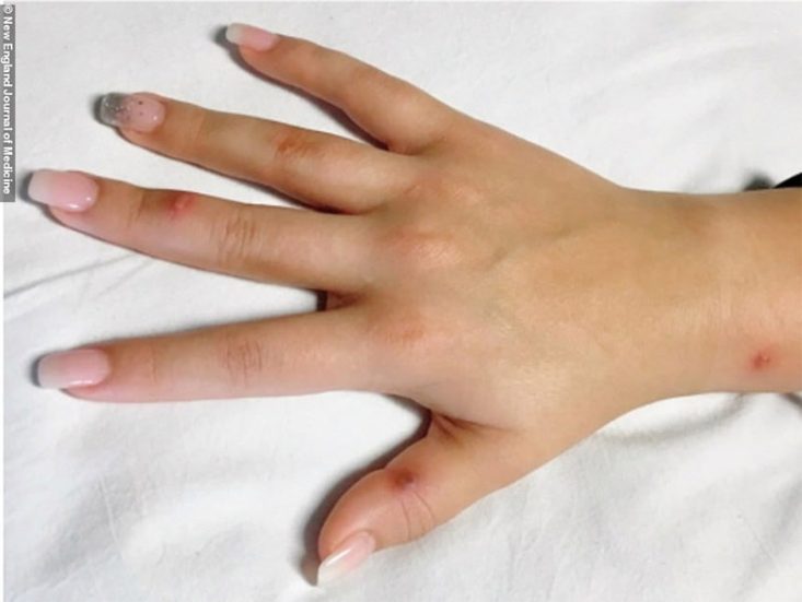 Lesiones de gonorrea en la mano.