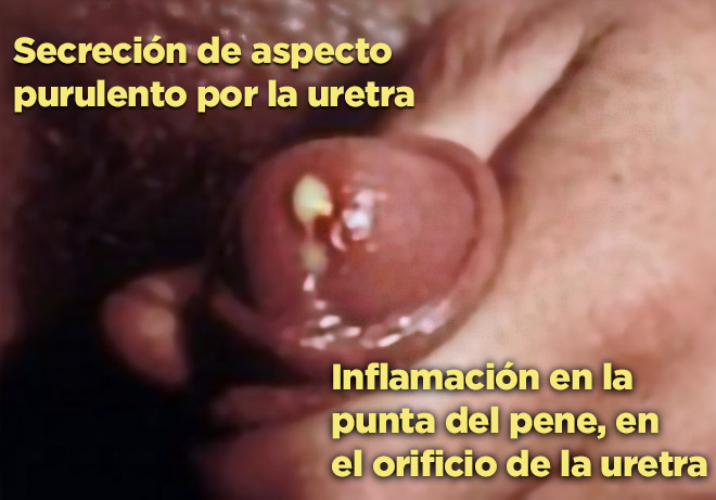 Uretritis en la gonorrea