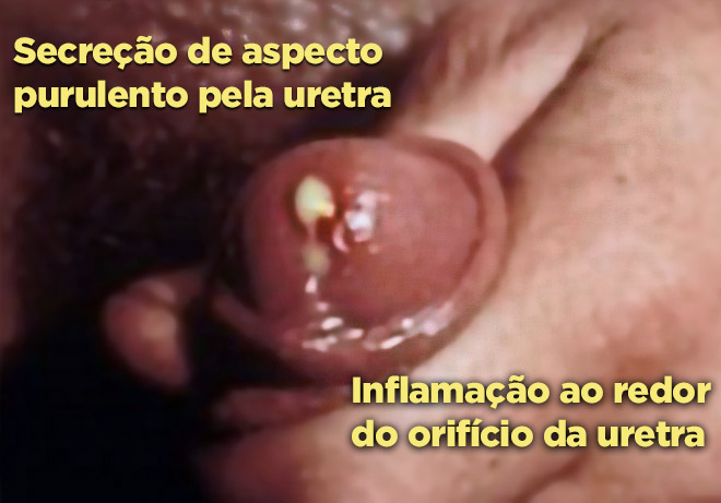 Corrimento uretral da gonorreia