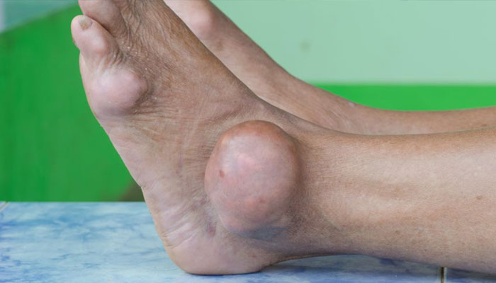 Tofo de gota