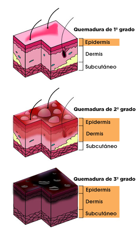 Grados de quemadura