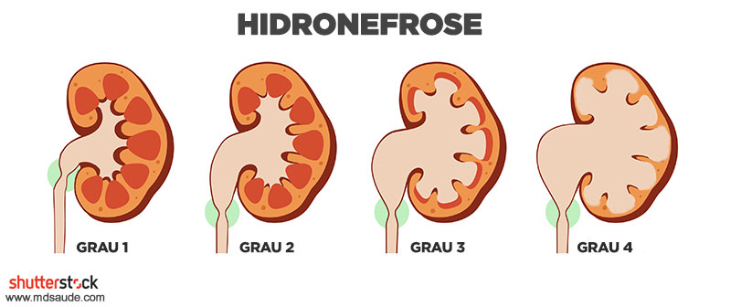 Graduação da hidronefrose