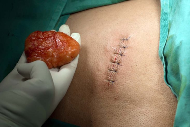 Grande lipoma nas costas removido cirurgicamente