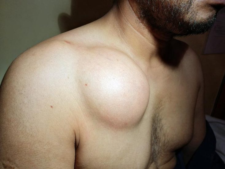 Grande lipoma no tronco